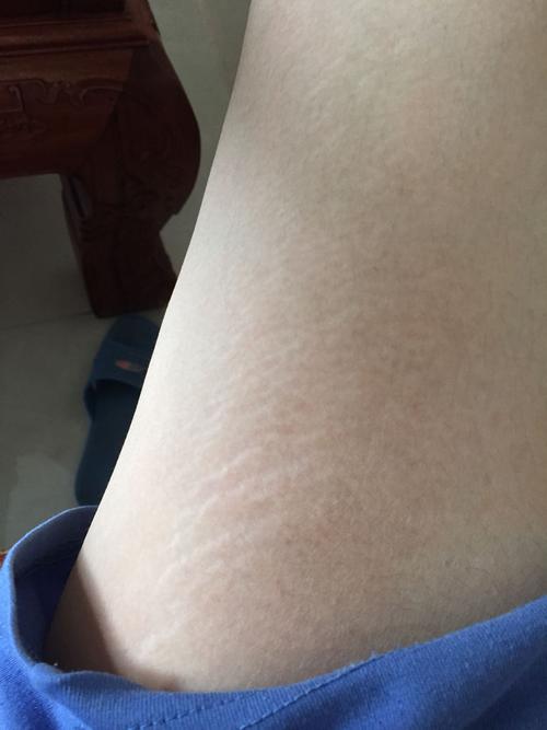 大腿内侧皮肤褶皱图片是正常现象吗?