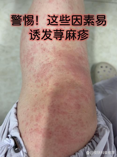 不明原因过敏皮肤瘙痒,究竟如何应对?