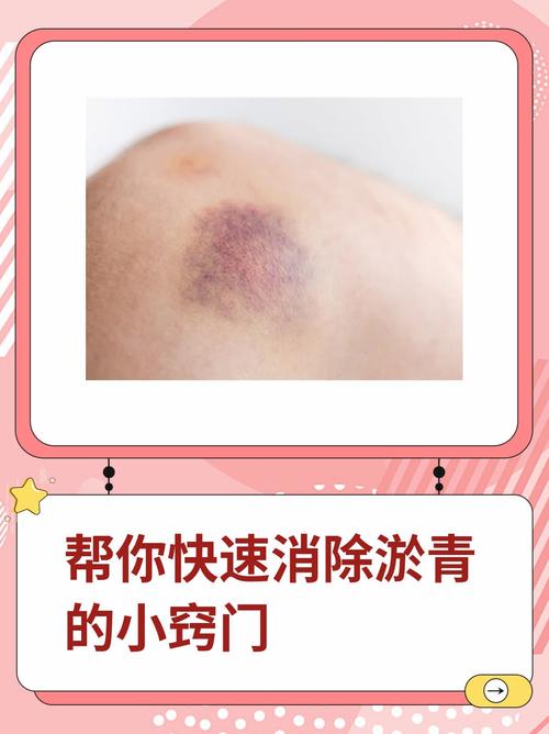 皮肤淤血快速消失的有效方法有哪些?