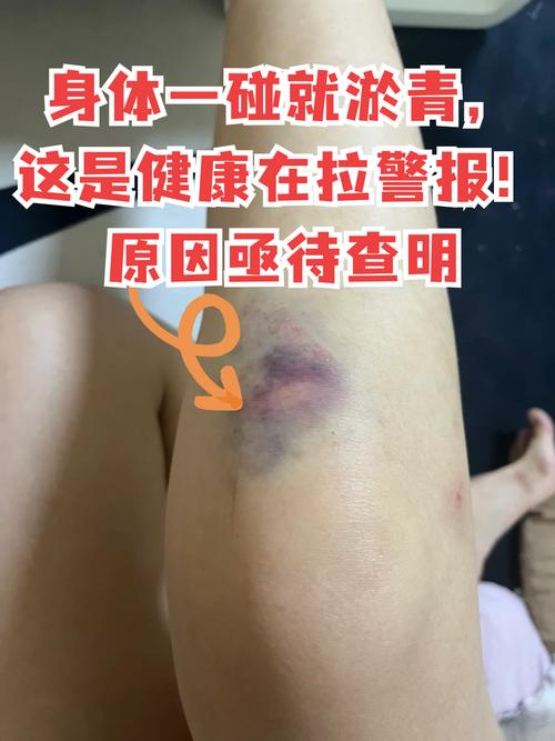 皮肤淤血快速消失的有效方法有哪些?