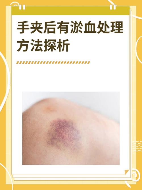 皮肤淤血快速消失的有效方法有哪些?