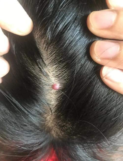 会变成皮肤癌的皮肤病