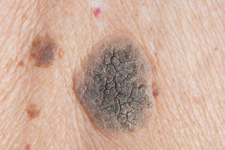 会变成皮肤癌的皮肤病