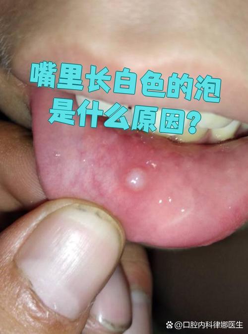 口腔起水泡是上火还是疾病?