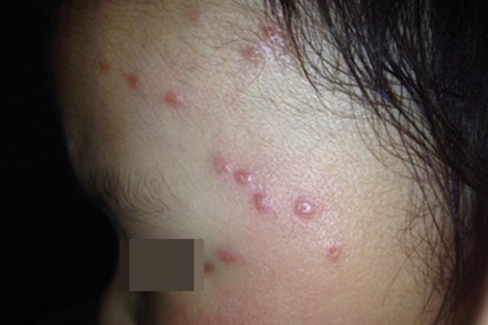 皮肤寄生虫病症状图片