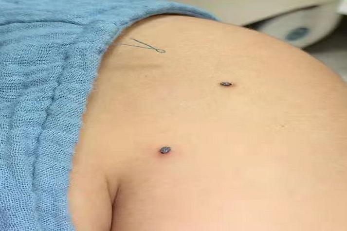 皮肤寄生虫病症状图片