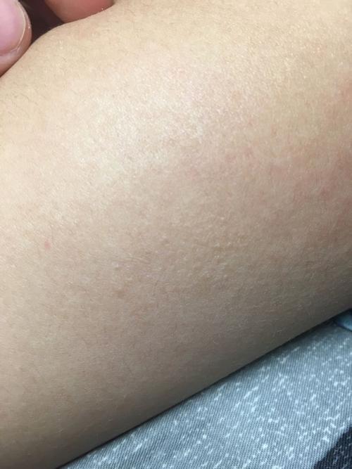 身上一小块粗糙皮肤是啥问题?