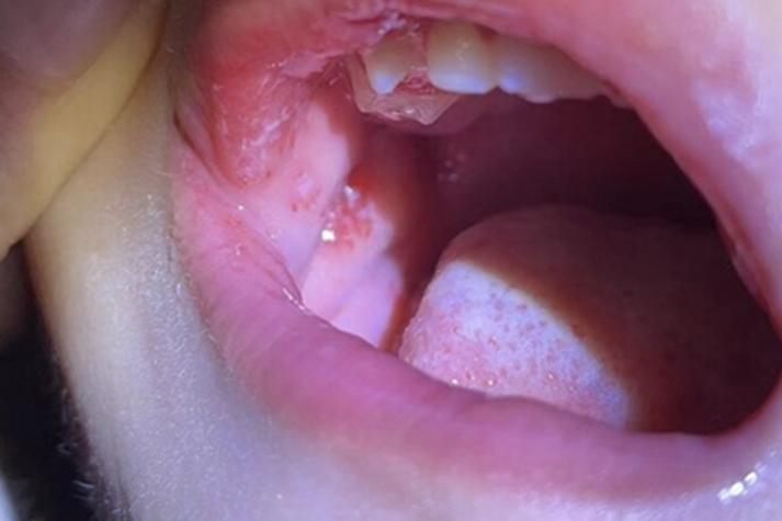 口腔白念珠菌感染如何有效治疗?