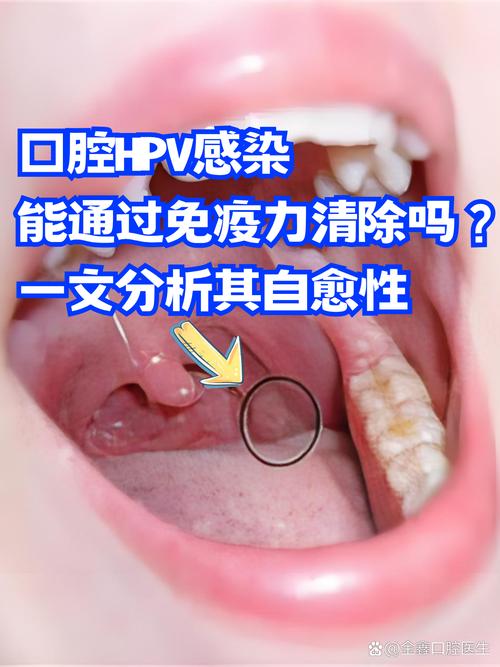 口腔白念珠菌感染如何有效治疗?