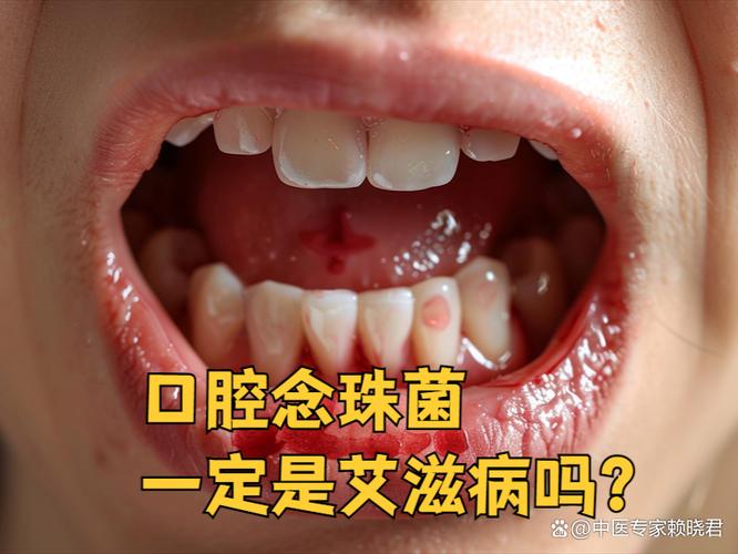 口腔白念珠菌感染如何有效治疗?