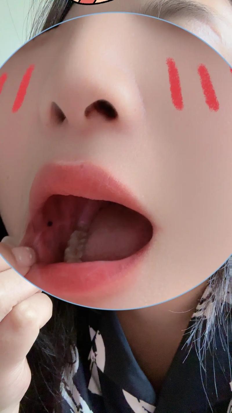 口腔内血泡咋回事?需处理吗?