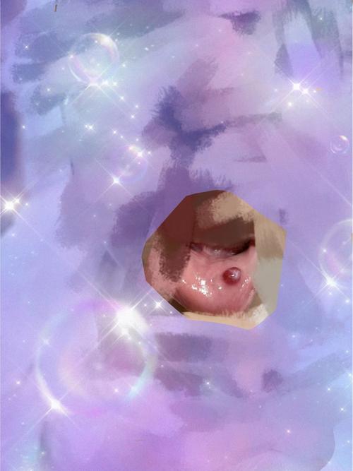 口腔内血泡咋回事?需处理吗?