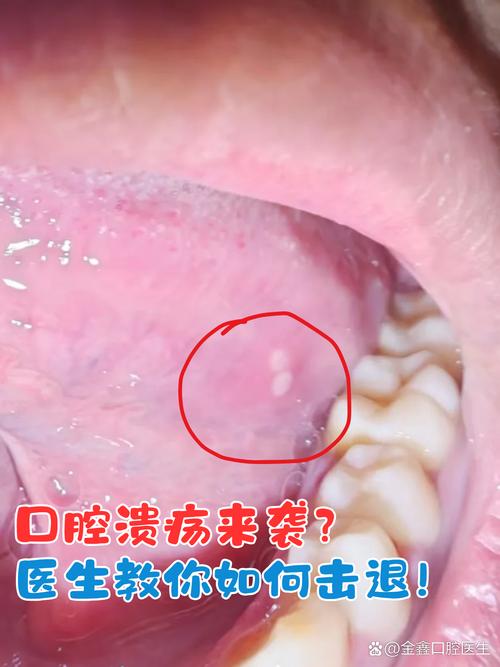长期口腔溃疡缺啥?营养还是疾病信号?