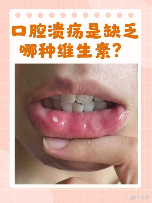 长期口腔溃疡缺啥?营养还是疾病信号?