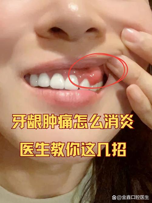 口腔上牙膛肿了怎么办