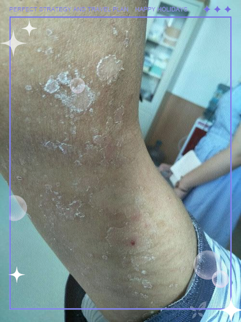 透析病人皮肤痒怎么办