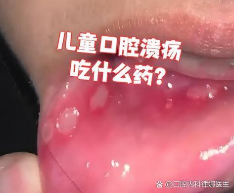 口腔溃疡吃什么能好得快?