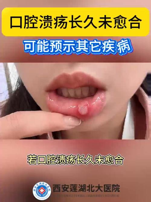 口腔溃疡的症状引起的