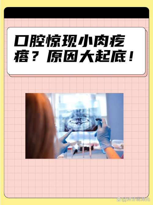 口腔长肉芽是何原因?