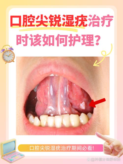 口腔尖锐湿疣激光治疗是否最佳选择?