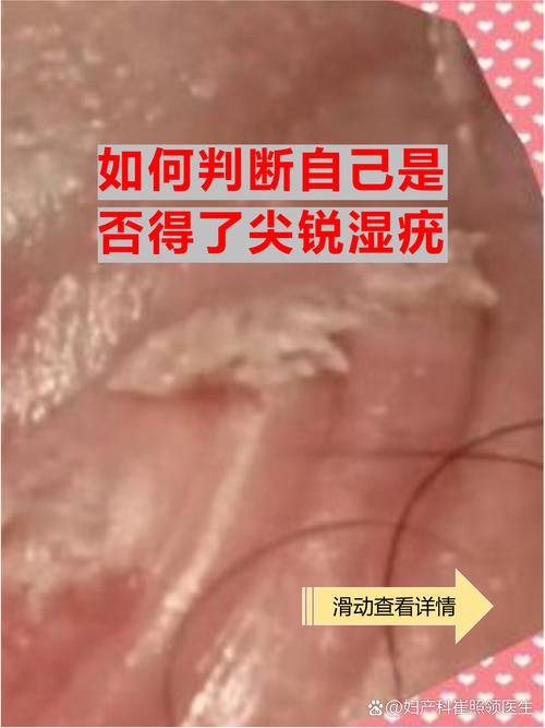 尖锐湿疣是看皮肤科吗