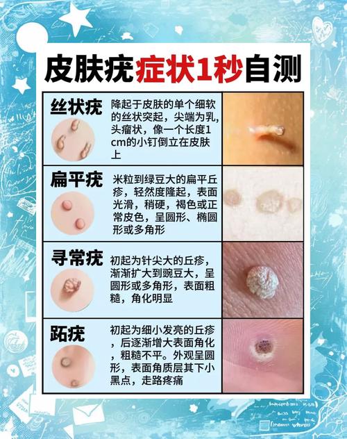 尖锐湿疣是看皮肤科吗