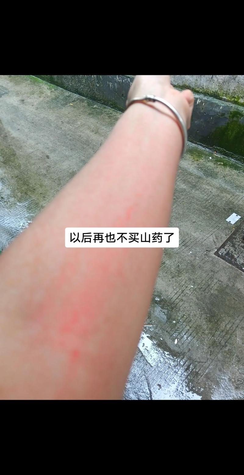 削山药皮手痒怎么办?