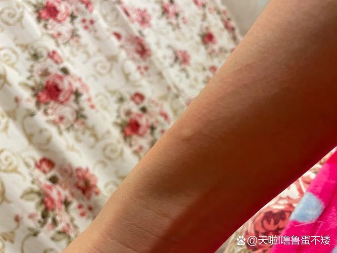 皮肤莫名瘙痒起包是何原因?