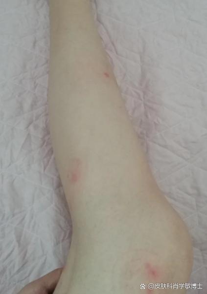 皮肤莫名瘙痒起包是何原因?