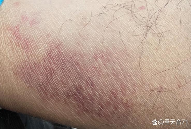 免疫力低下皮肤病图片有哪些症状表现?