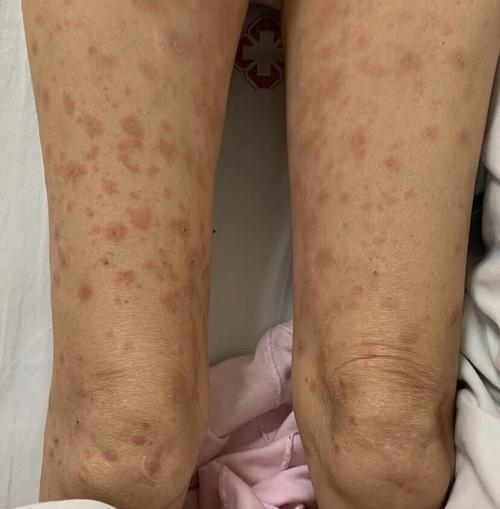 免疫力低下皮肤病图片有哪些症状表现?