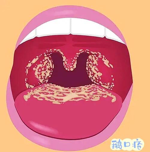 为什么会得口腔念珠菌