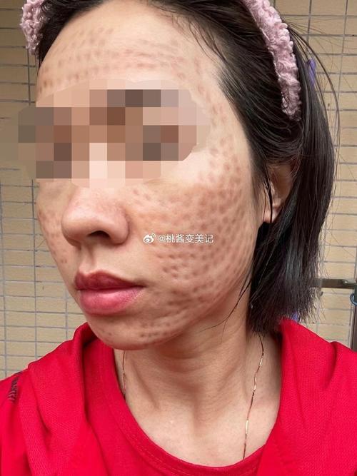 皮肤过敏能打水光针吗