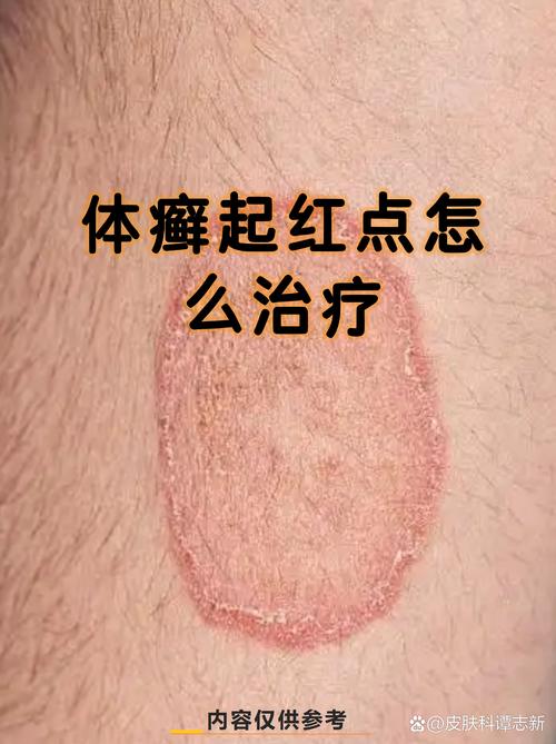 皮肤病真菌感染怎么办