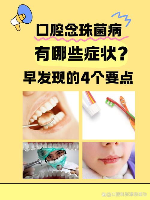 口腔白色念球菌怎么治?