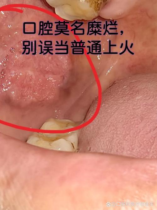 口腔白色念球菌怎么治?
