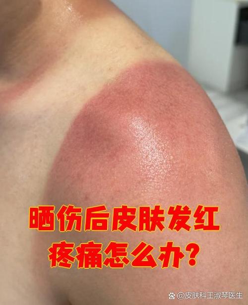 晒伤的皮肤为什么会痒