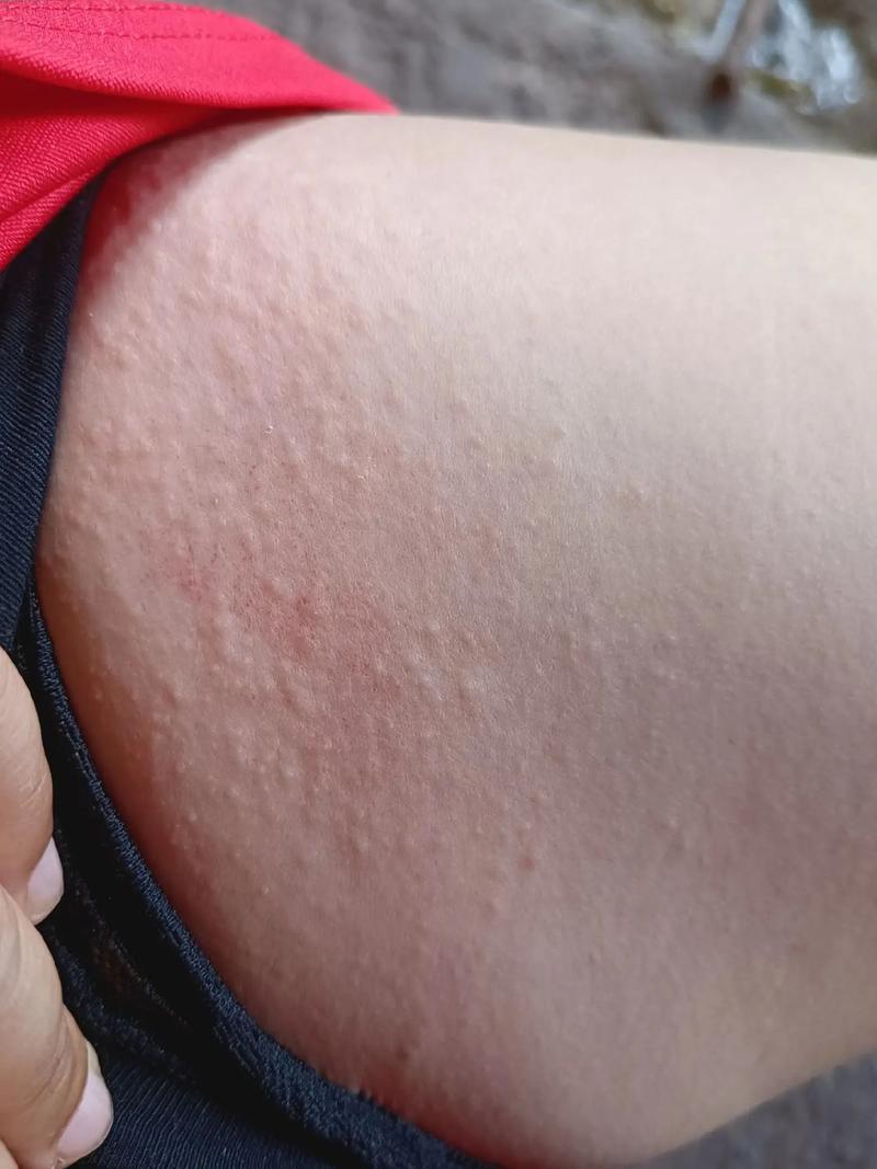 为何晚上皮肤痒,白天却安然无恙?