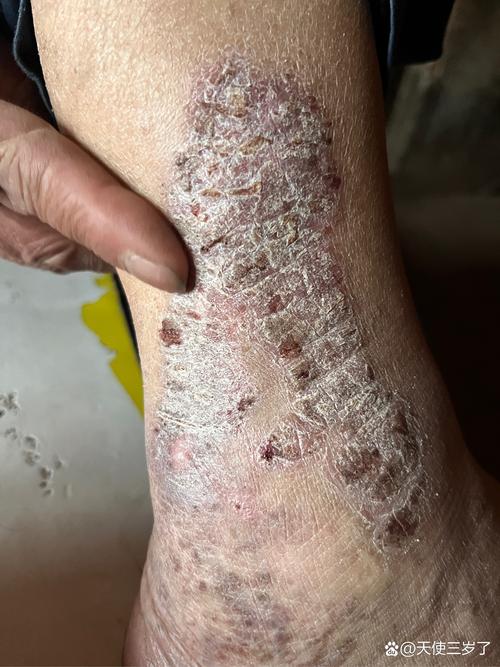 为何晚上皮肤痒,白天却安然无恙?