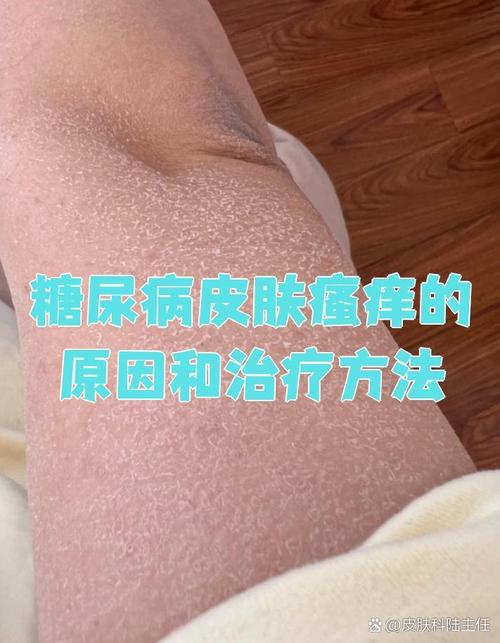 糖尿病皮肤痒什么症状