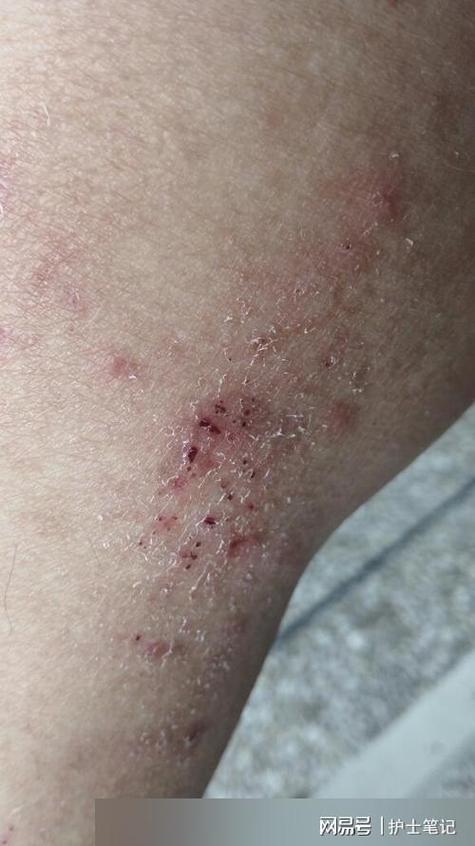 糖尿病皮肤痒什么症状