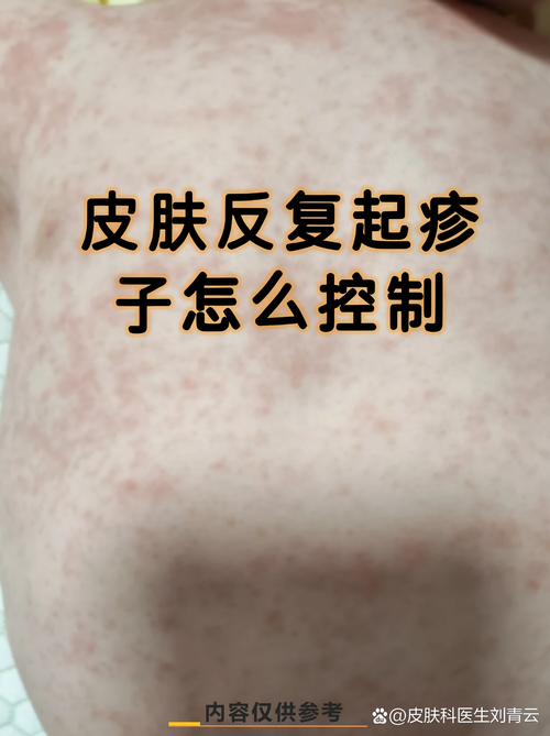 接触性皮肤过敏怎么办