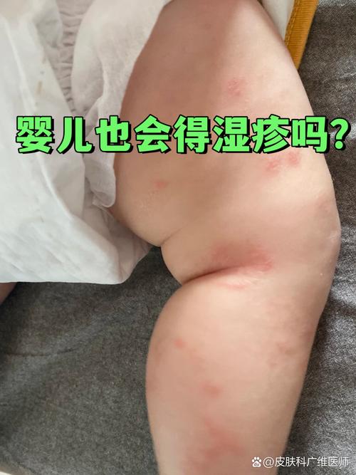 婴儿皮肤病有哪些?附图片识别指南。