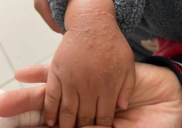 婴儿皮肤病有哪些?附图片识别指南。