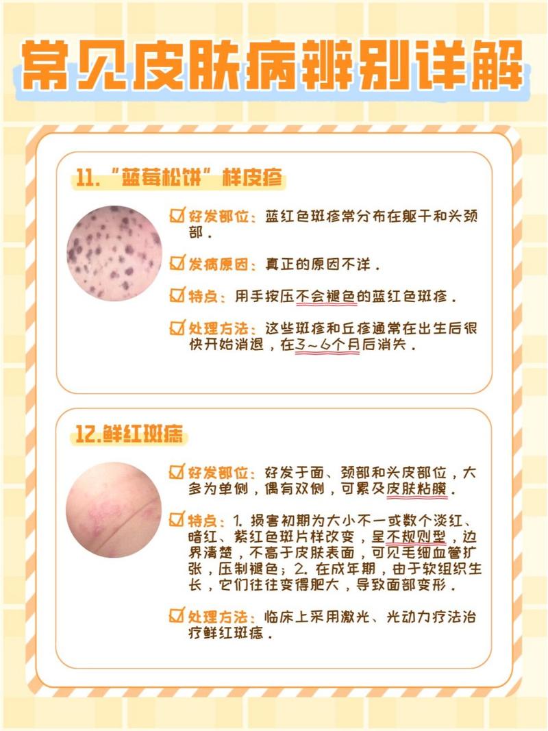 婴儿皮肤病有哪些?附图片识别指南。
