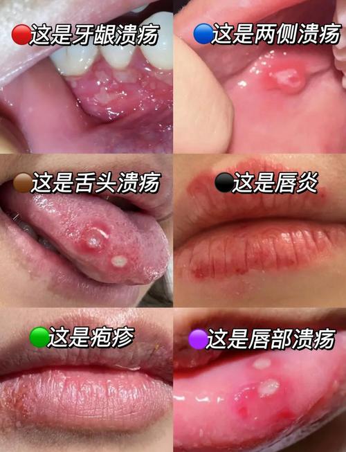 宝宝口腔溃疡怎么治?