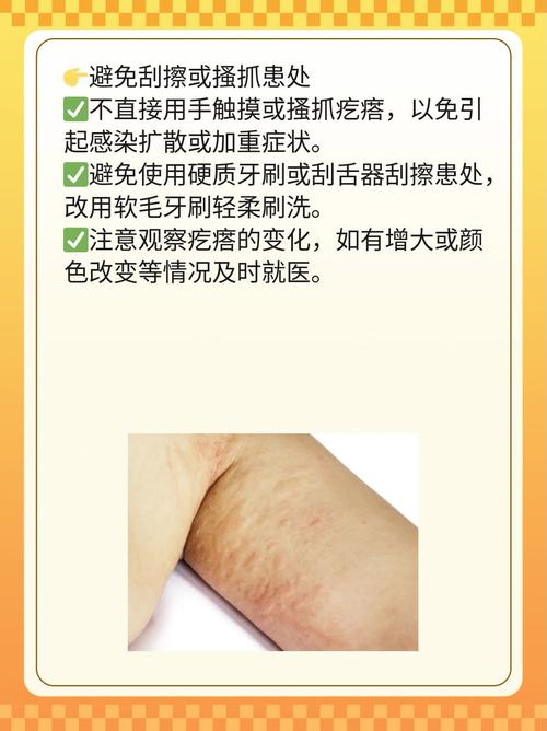 口腔尖锐湿尤怎么治疗