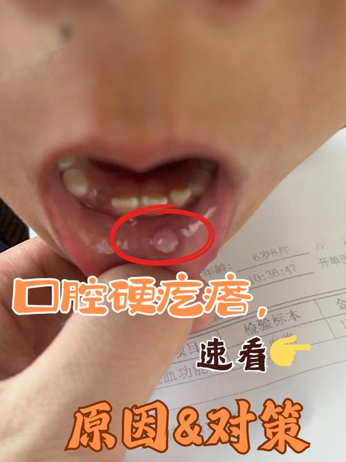 口腔最里肉痛肿是智齿发炎了吗?