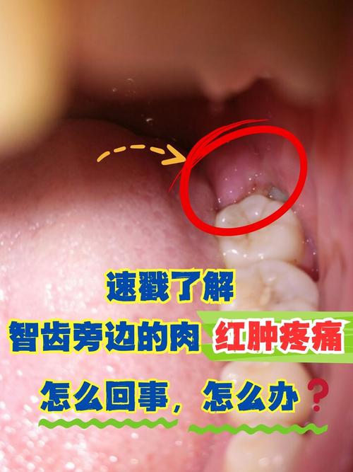 口腔最里肉痛肿是智齿发炎了吗?