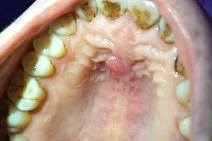 口腔最里肉痛肿是智齿发炎了吗?